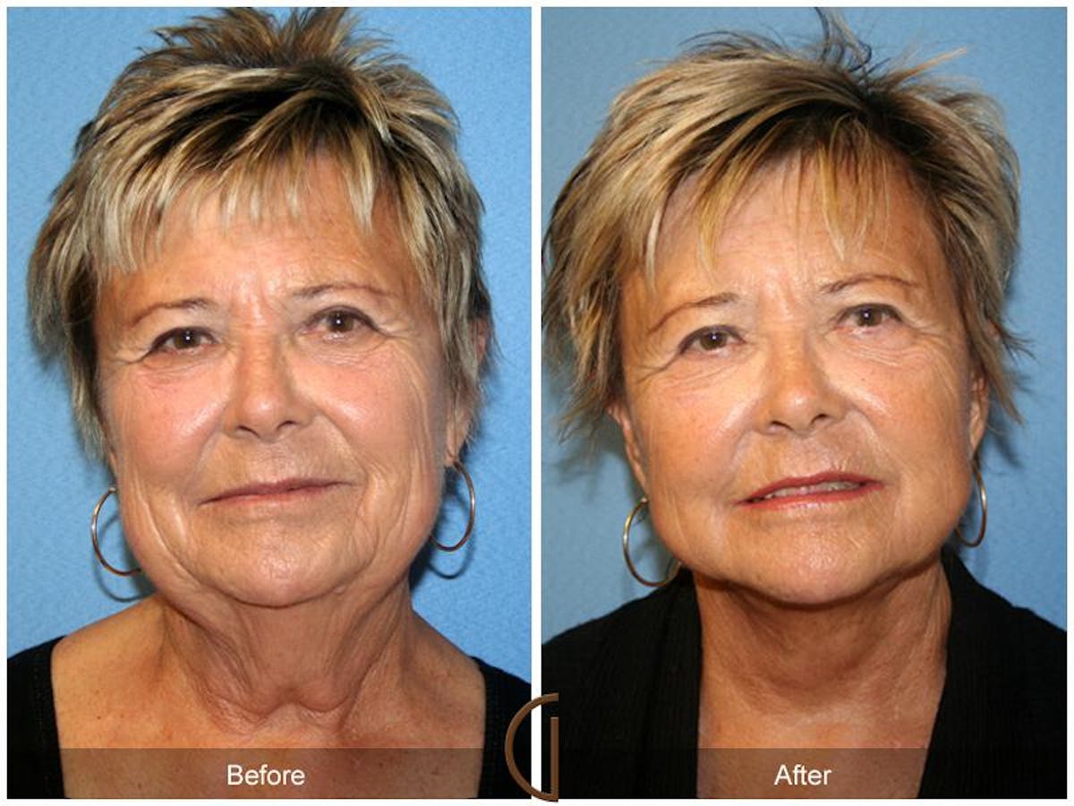 Facelift 70s Before & After Gallery - Patient 247597 - Image 2