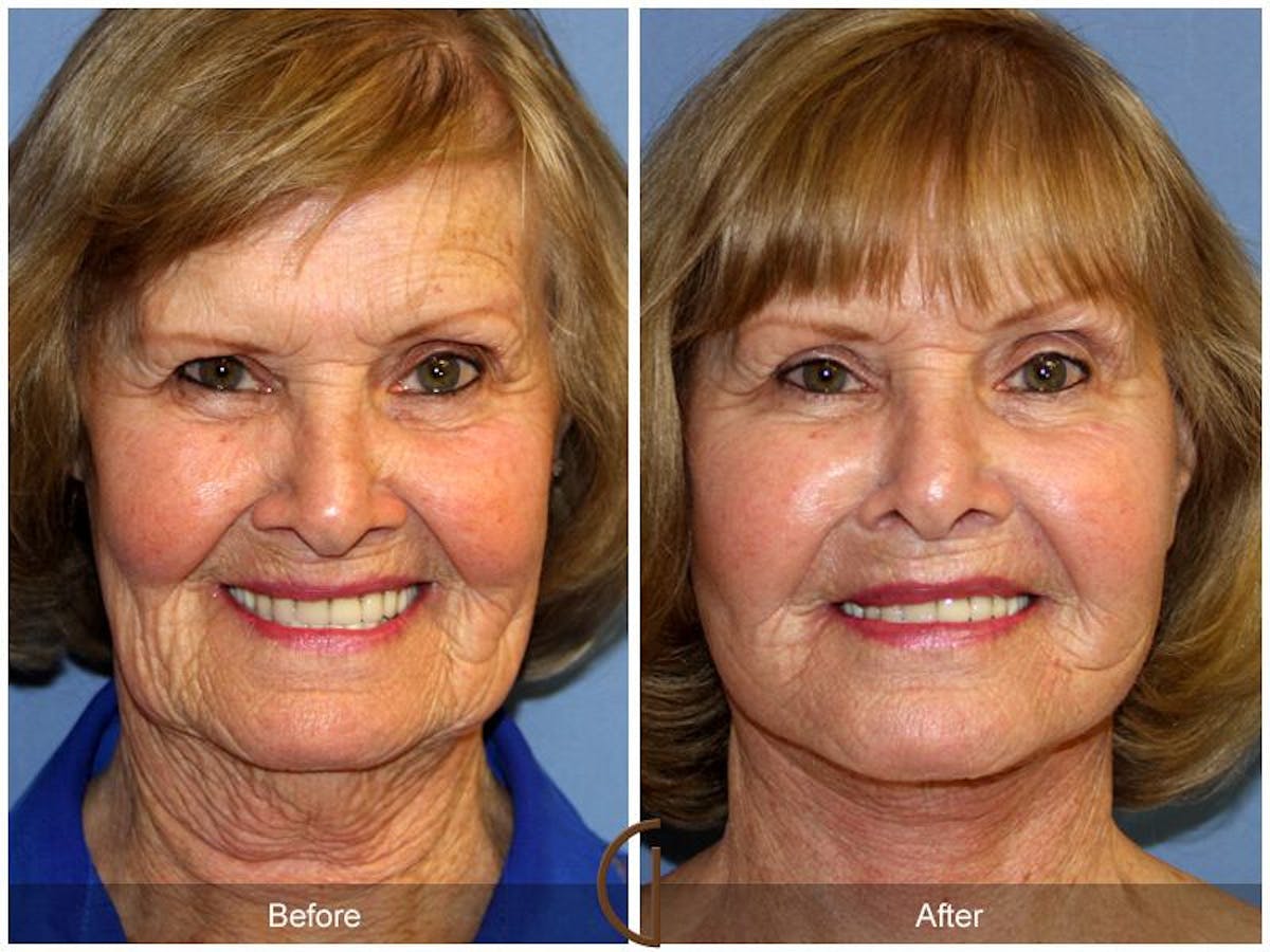 Facelift 70s Before & After Gallery - Patient 591519 - Image 2