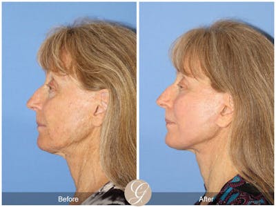 Facelift 70s Before & After Gallery - Patient 207451 - Image 1