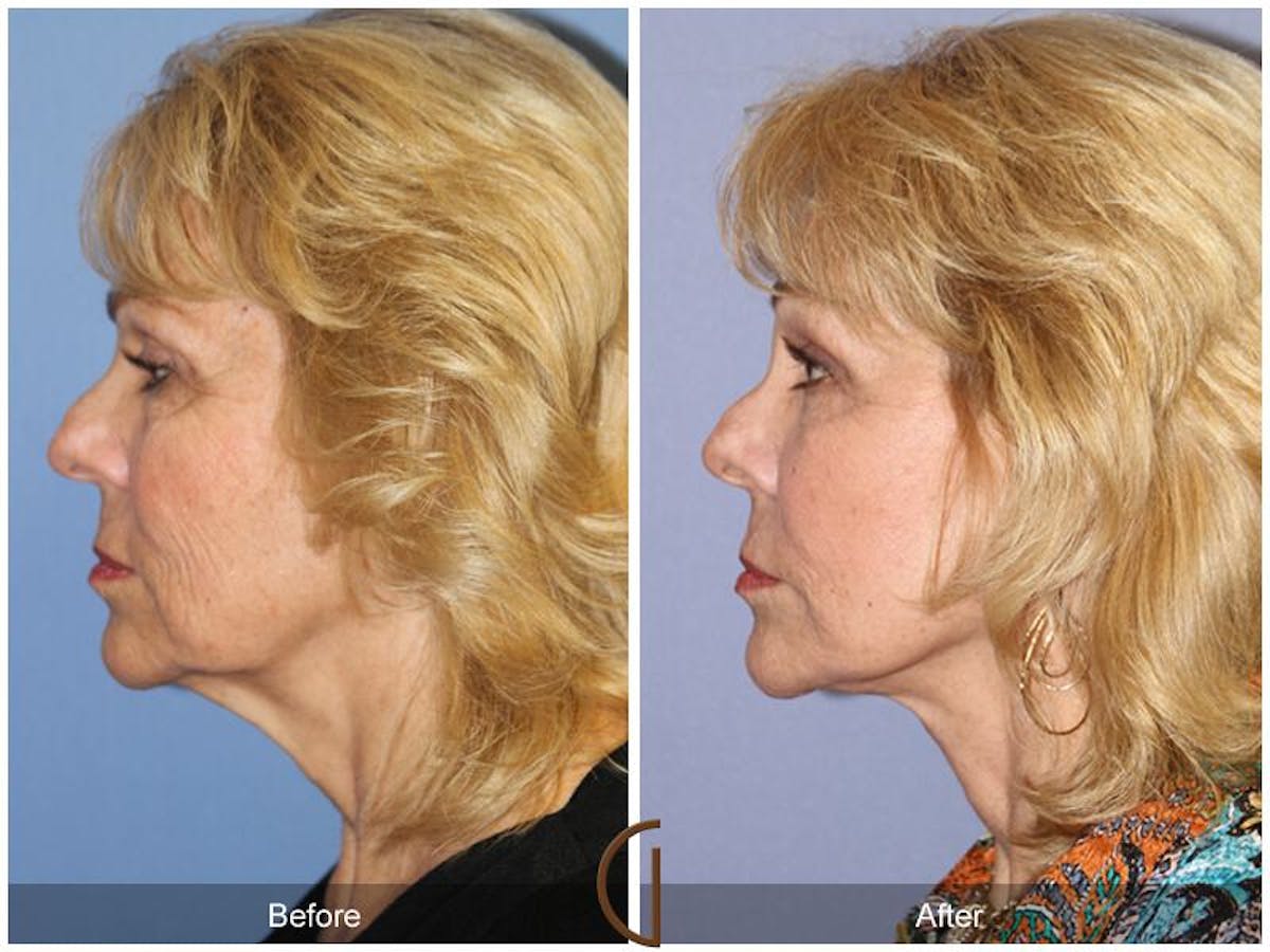 Facelift 70s Before & After Gallery - Patient 293749 - Image 1