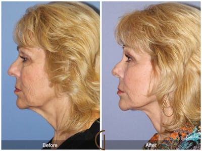 Facelift 70s Before & After Gallery - Patient 293749 - Image 1