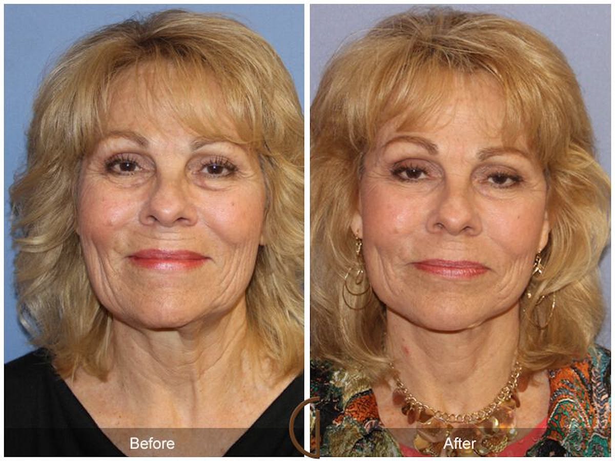 Facelift 70s Before & After Gallery - Patient 293749 - Image 2