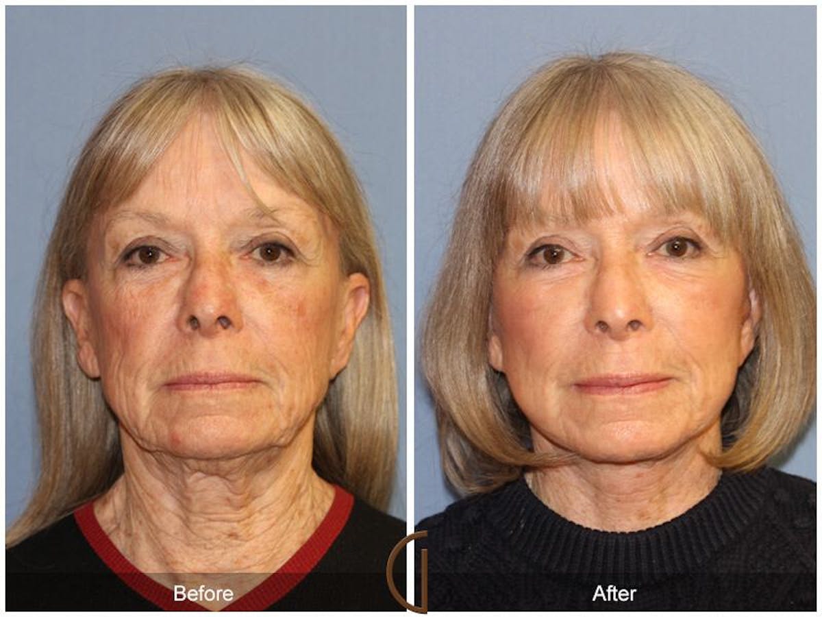 Facelift 70s Before & After Gallery - Patient 255873 - Image 2