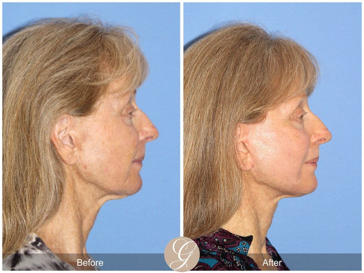 Facelift 70s Before & After Gallery - Patient 207451 - Image 3