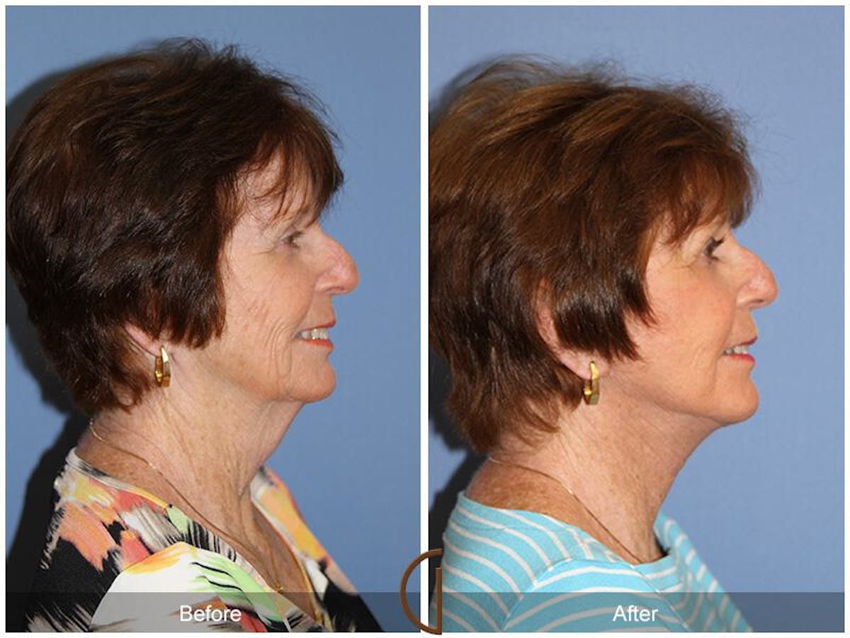 Facelift 70s Before & After Gallery - Patient 173205 - Image 3