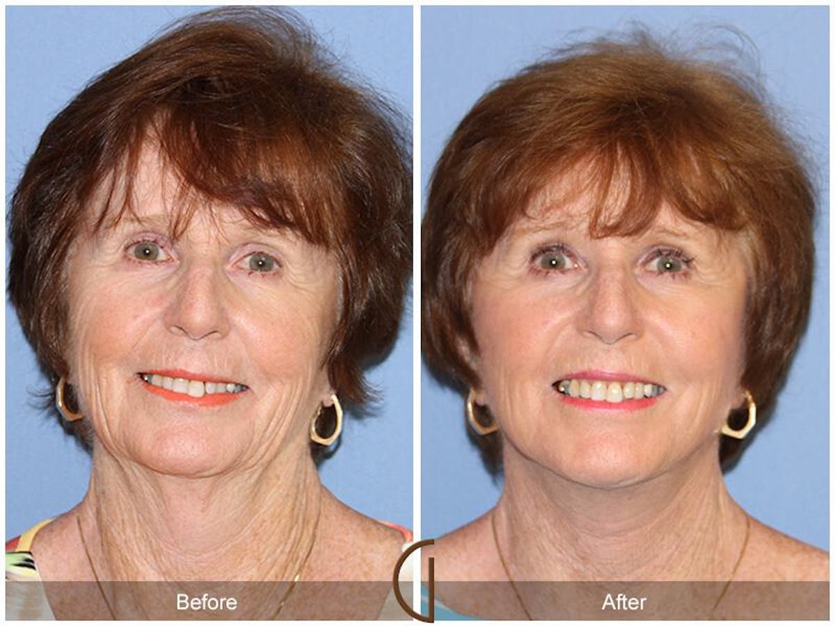 Facelift 70s Before & After Gallery - Patient 173205 - Image 2