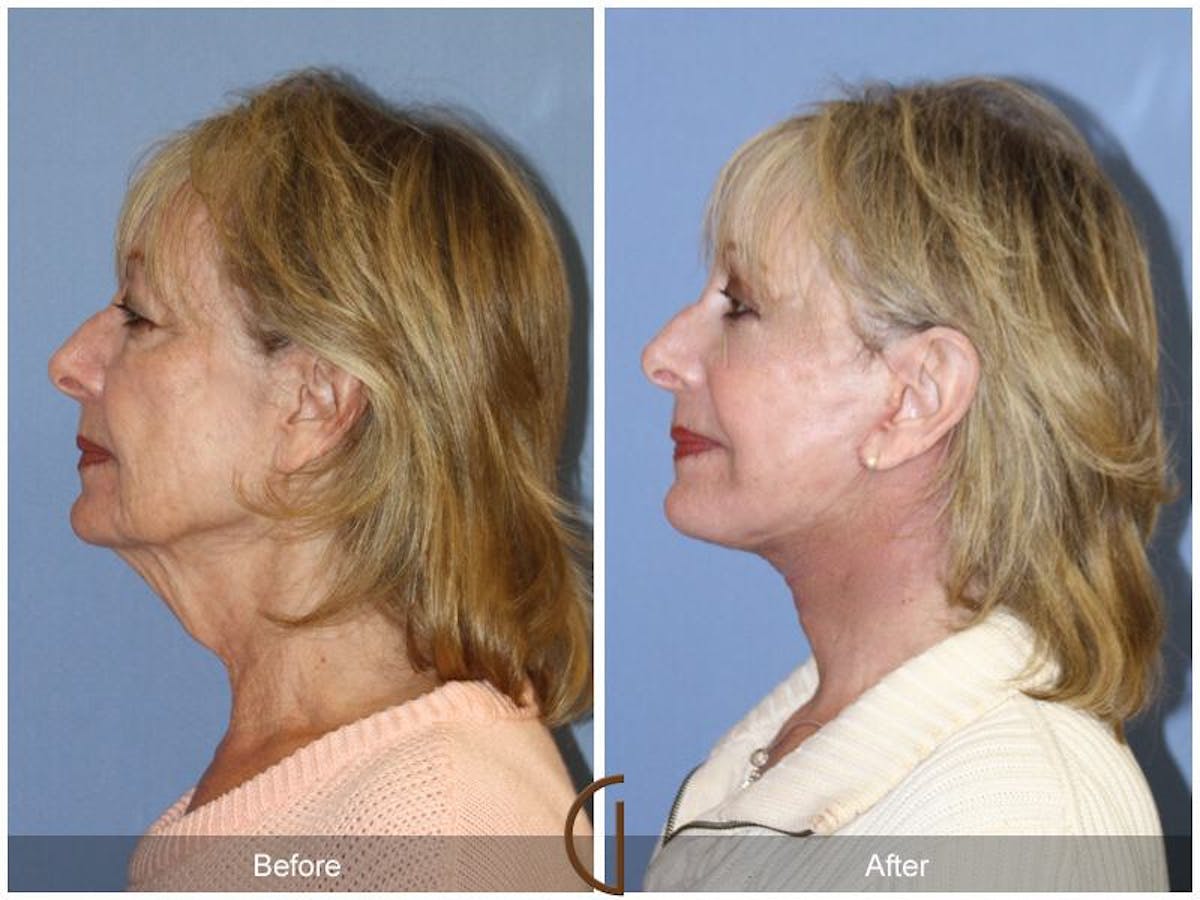 Facelift 70s Before & After Gallery - Patient 326542 - Image 1