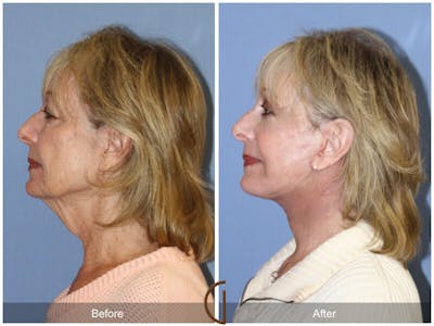 Facelift 70s Before & After Gallery - Patient 326542 - Image 1
