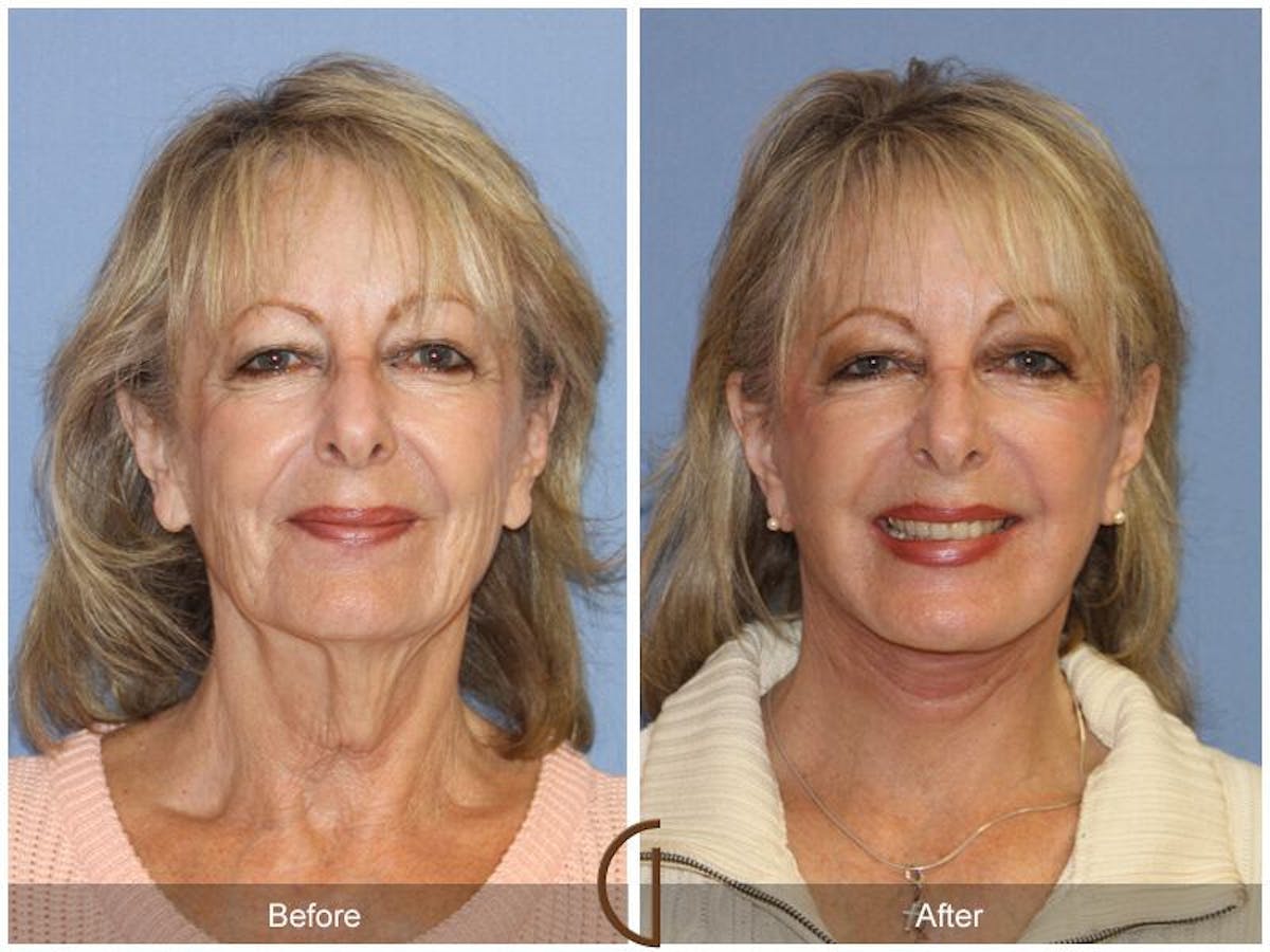 Facelift 70s Before & After Gallery - Patient 326542 - Image 2
