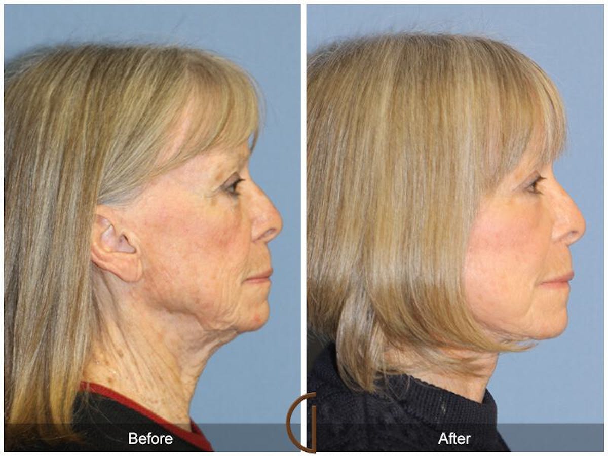 Facelift 70s Before & After Gallery - Patient 255873 - Image 3