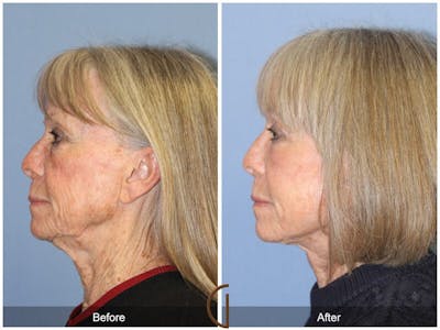 Facelift 70s Before & After Gallery - Patient 255873 - Image 1