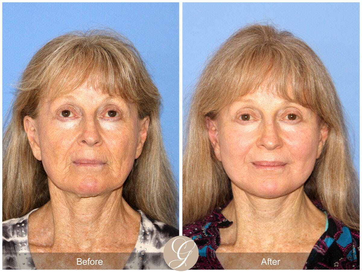 Facelift 70s Before & After Gallery - Patient 207451 - Image 2