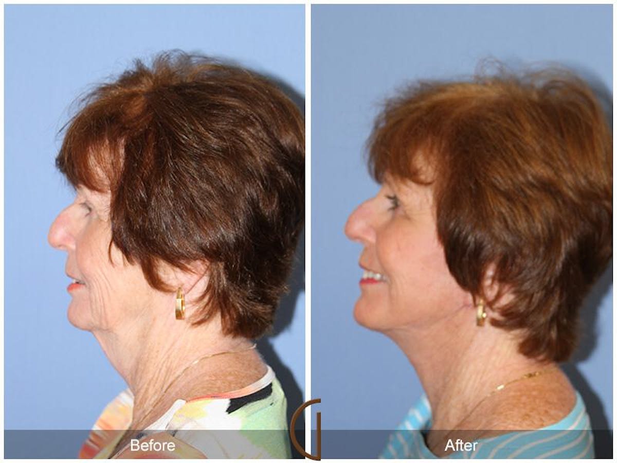 Facelift 70s Before & After Gallery - Patient 173205 - Image 1