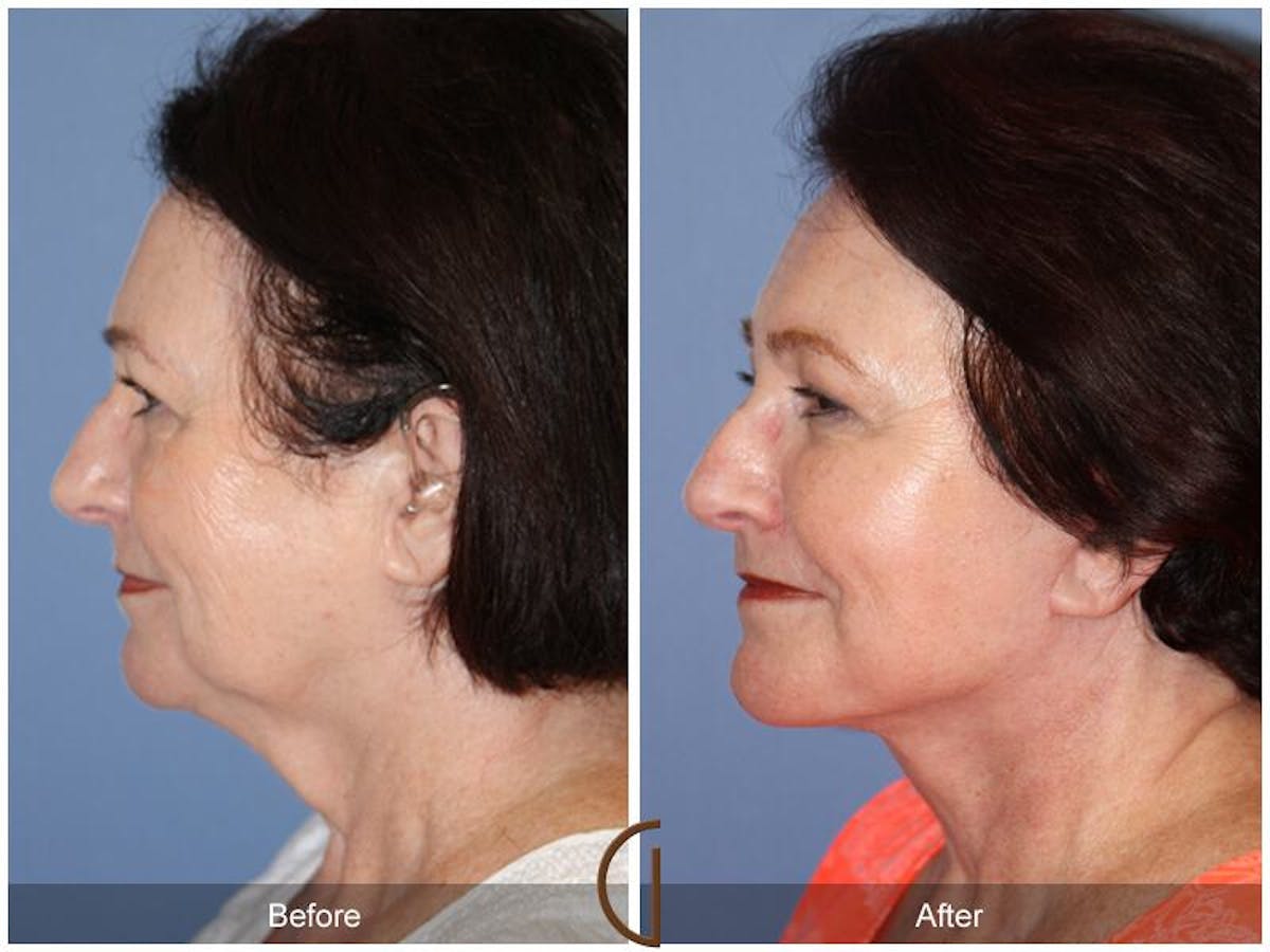 Facelift 70s Before & After Gallery - Patient 293335 - Image 1