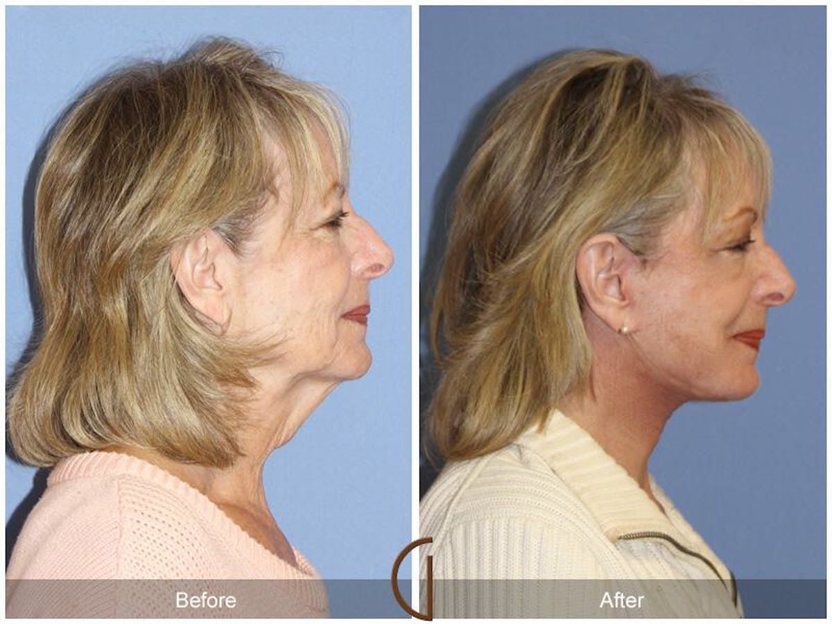 Facelift 70s Before & After Gallery - Patient 326542 - Image 3
