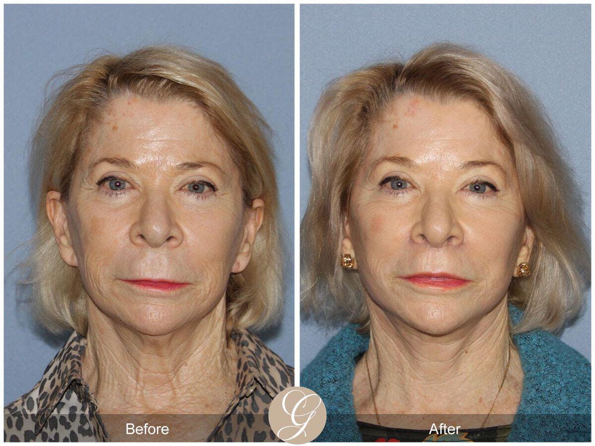 Facelift 70s Before & After Gallery - Patient 172423 - Image 2