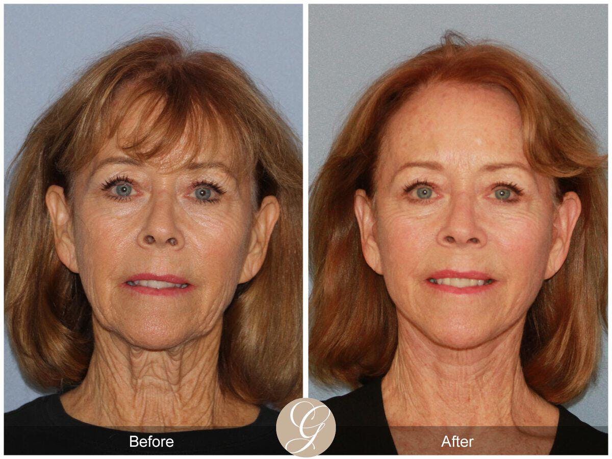 Facelift 70s Before & After Gallery - Patient 246360 - Image 2