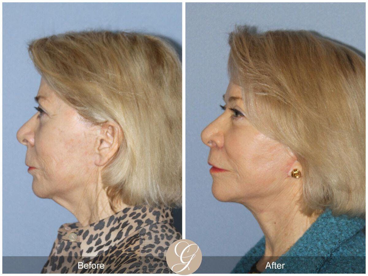 Facelift 70s Before & After Gallery - Patient 172423 - Image 1