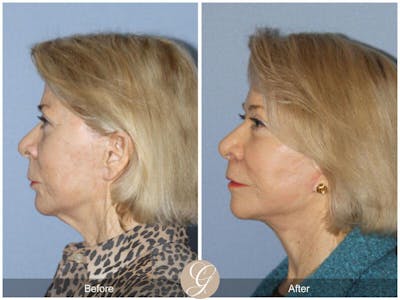 Facelift 70s Before & After Gallery - Patient 172423 - Image 1