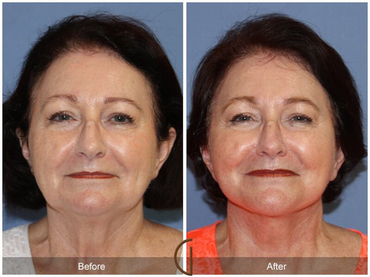 Facelift 70s Before & After Gallery - Patient 293335 - Image 2