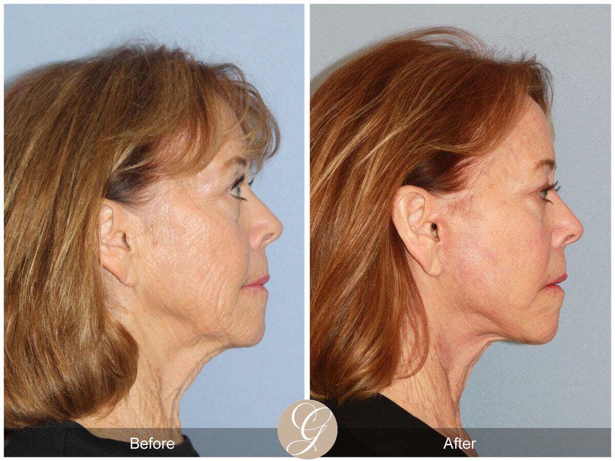 Facelift 70s Before & After Gallery - Patient 246360 - Image 3