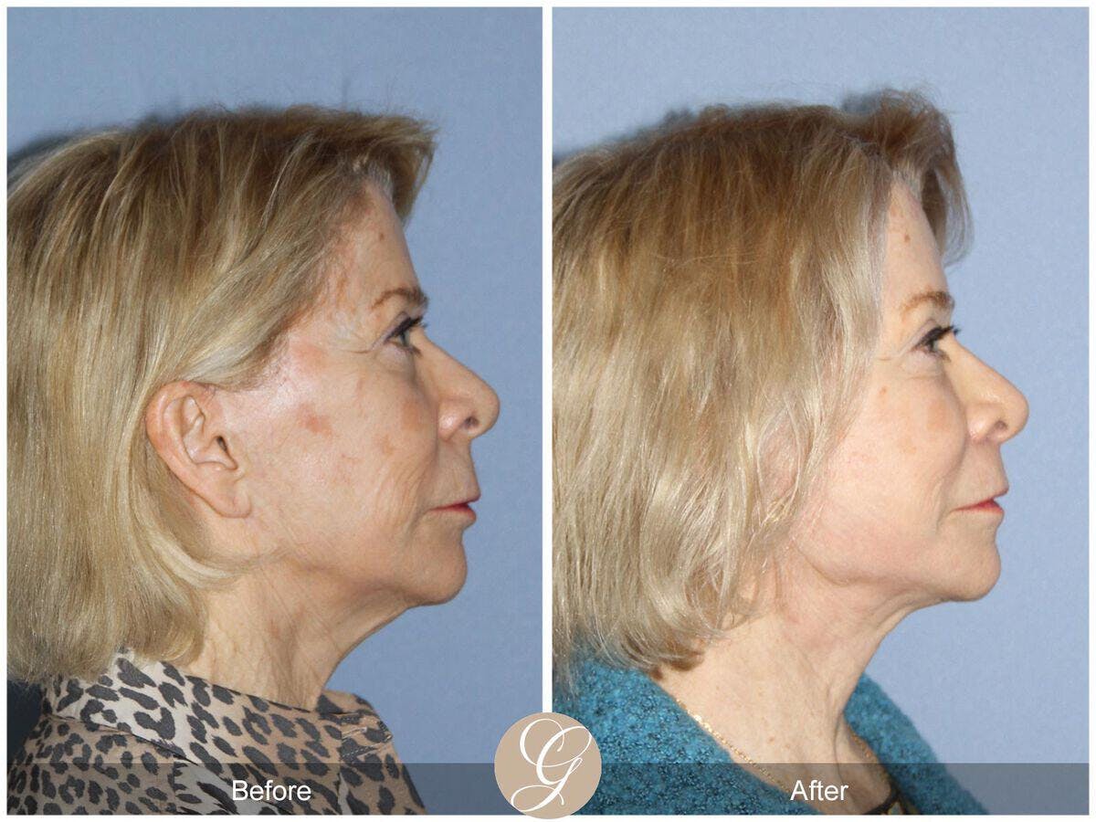 Facelift 70s Before & After Gallery - Patient 172423 - Image 3