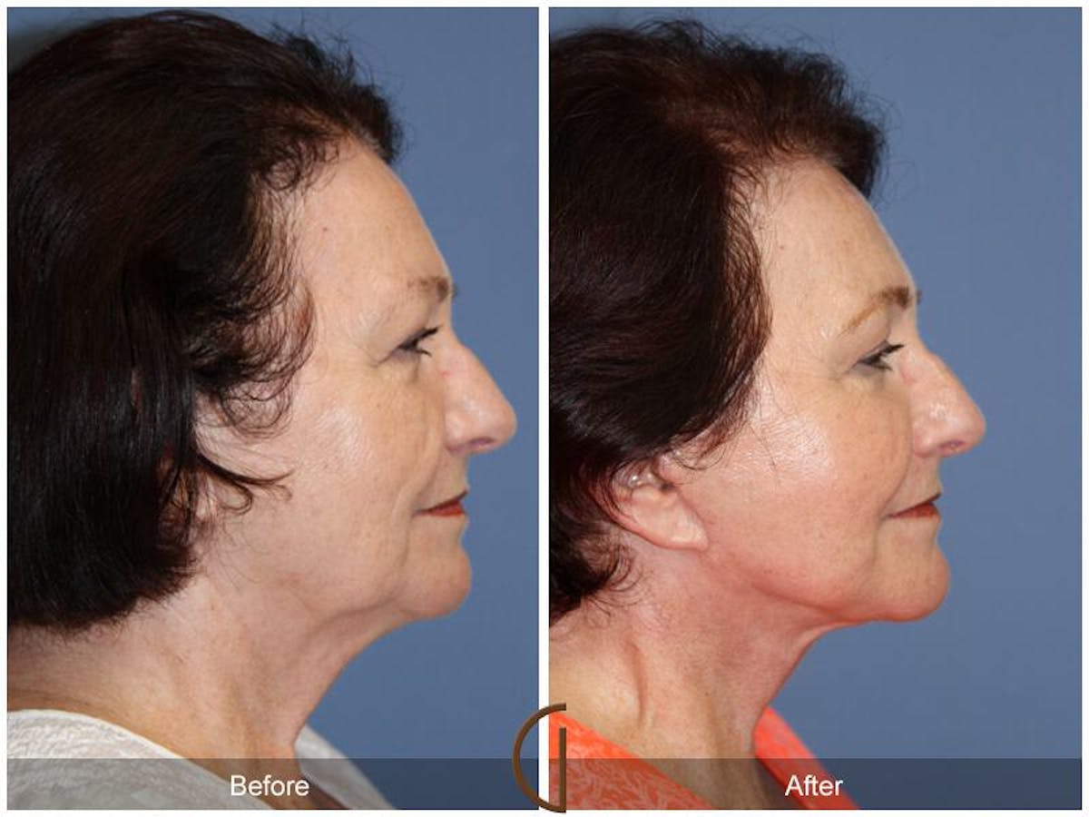 Facelift 70s Before & After Gallery - Patient 293335 - Image 3