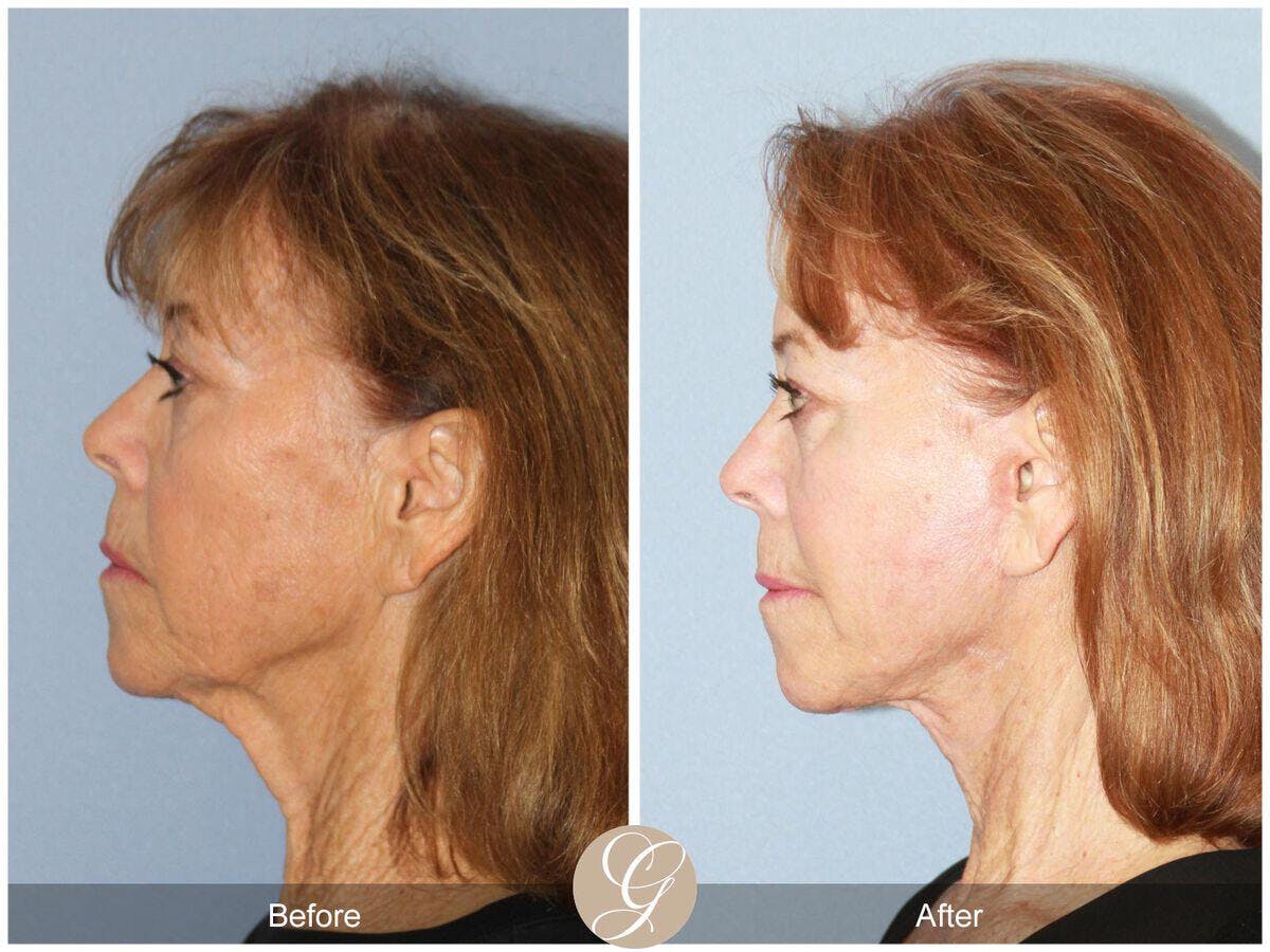 Facelift 70s Before & After Gallery - Patient 246360 - Image 1