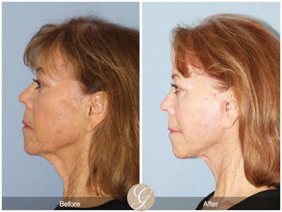Facelift 70s Before & After Gallery - Patient 246360 - Image 1