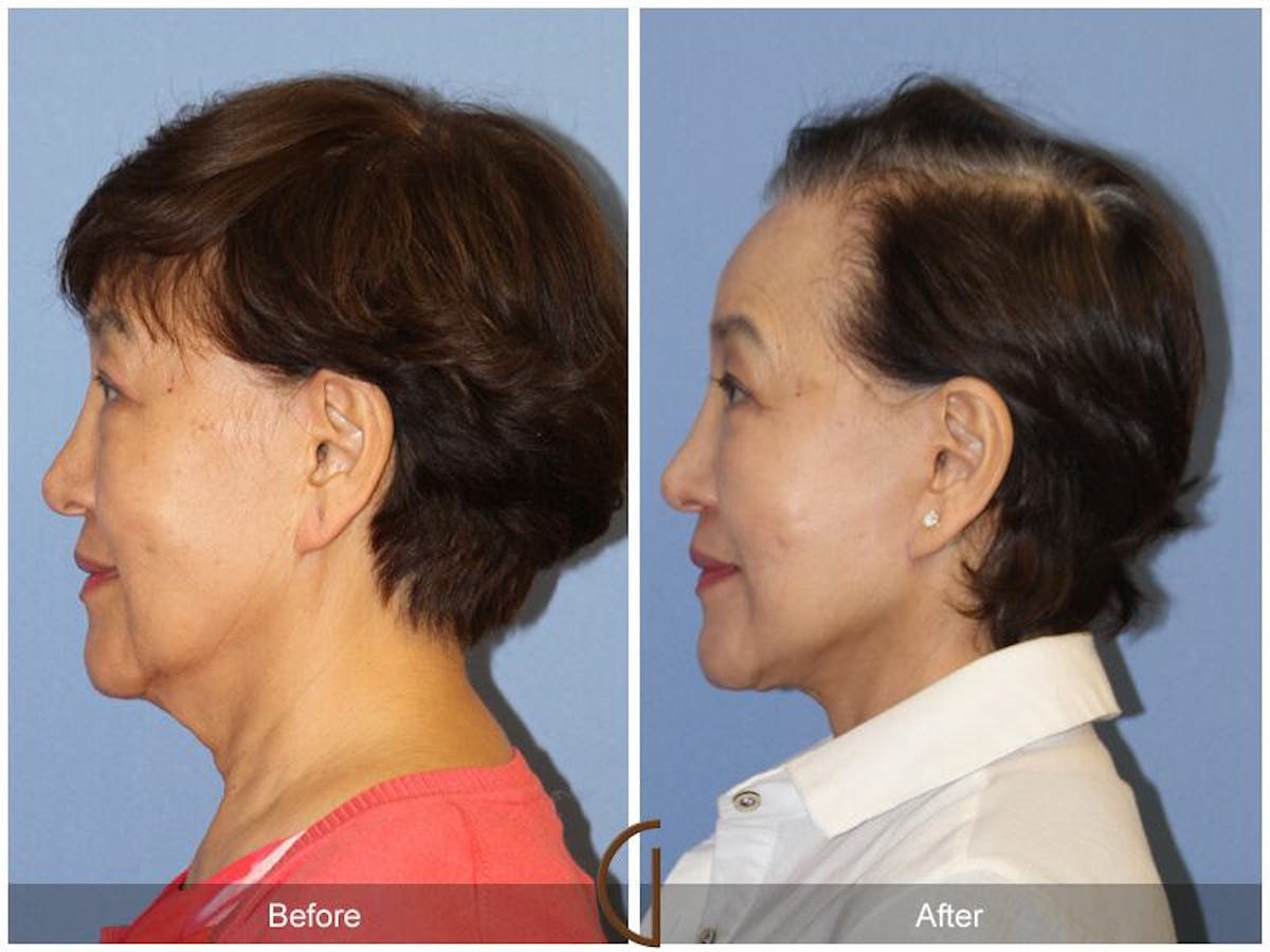 Facelift 70s Before & After Gallery - Patient 386180 - Image 1