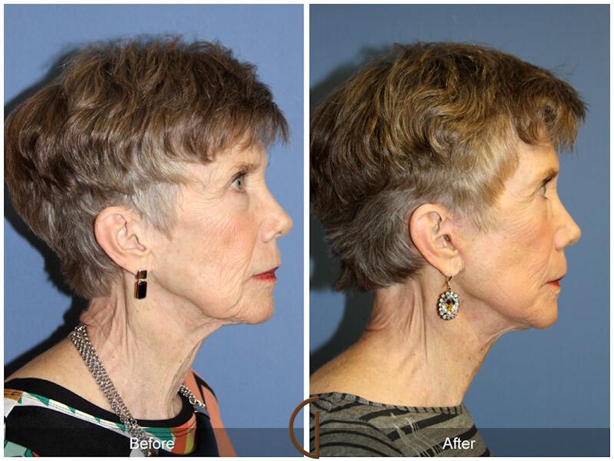Facelift 70s Before & After Gallery - Patient 388116 - Image 3