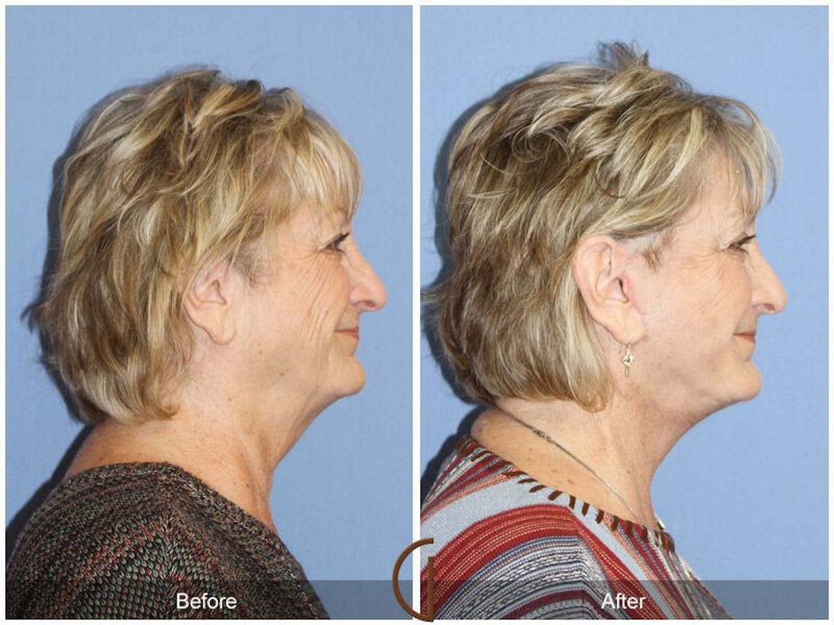 Facelift 70s Before & After Gallery - Patient 235710 - Image 3