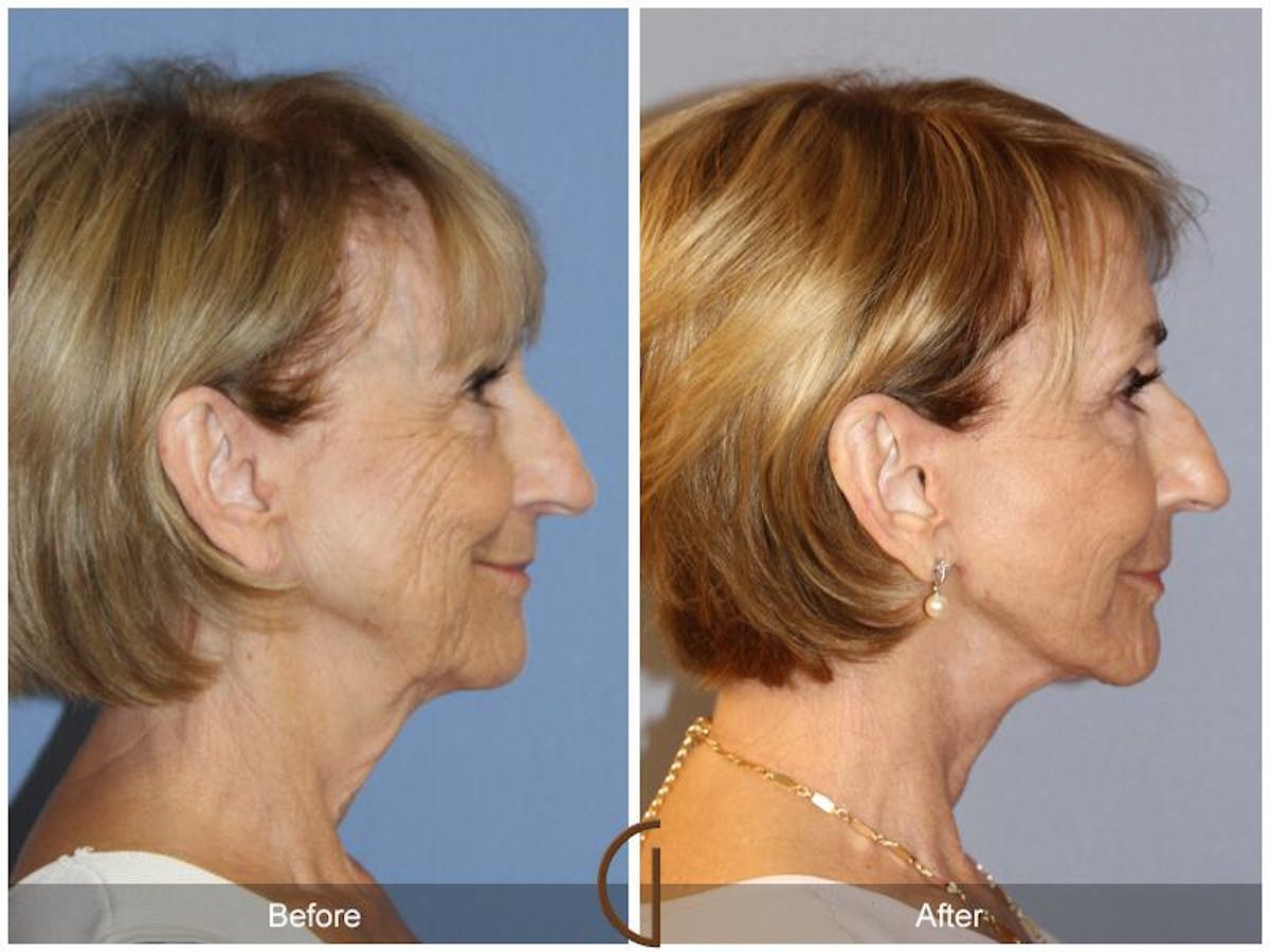 Facelift 70s Before & After Gallery - Patient 279768 - Image 3