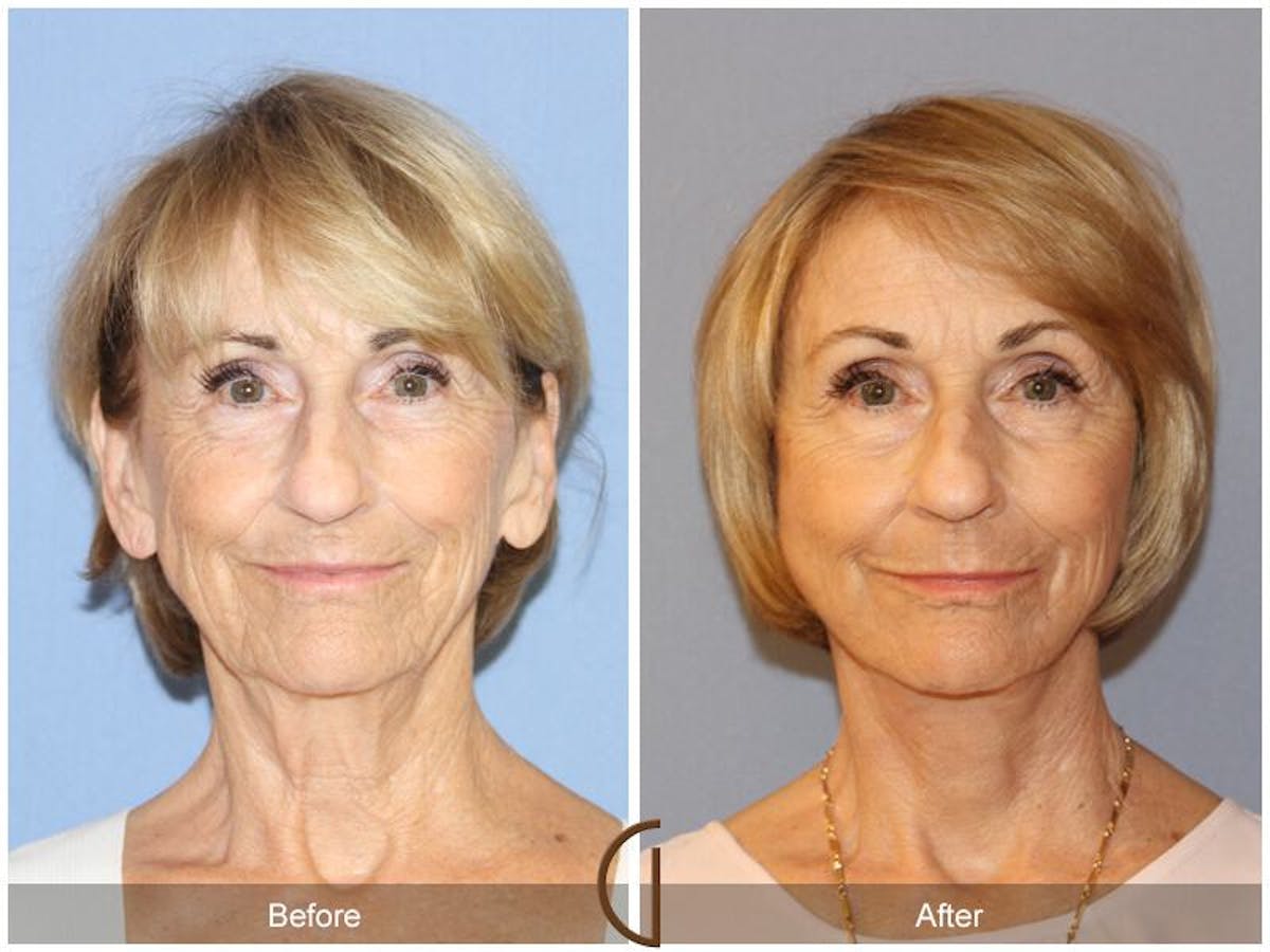 Facelift 70s Before & After Gallery - Patient 279768 - Image 2