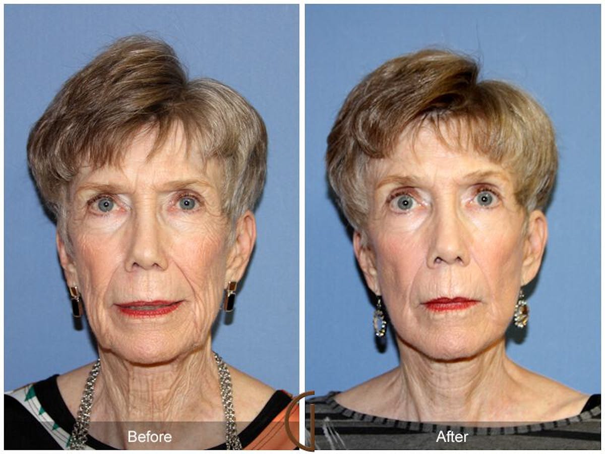 Facelift 70s Before & After Gallery - Patient 388116 - Image 2