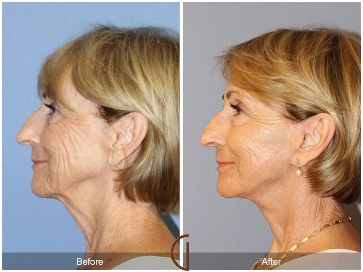 Facelift 70s Before & After Gallery - Patient 279768 - Image 1