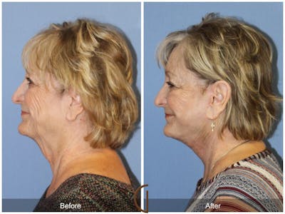 Facelift 70s Before & After Gallery - Patient 235710 - Image 1