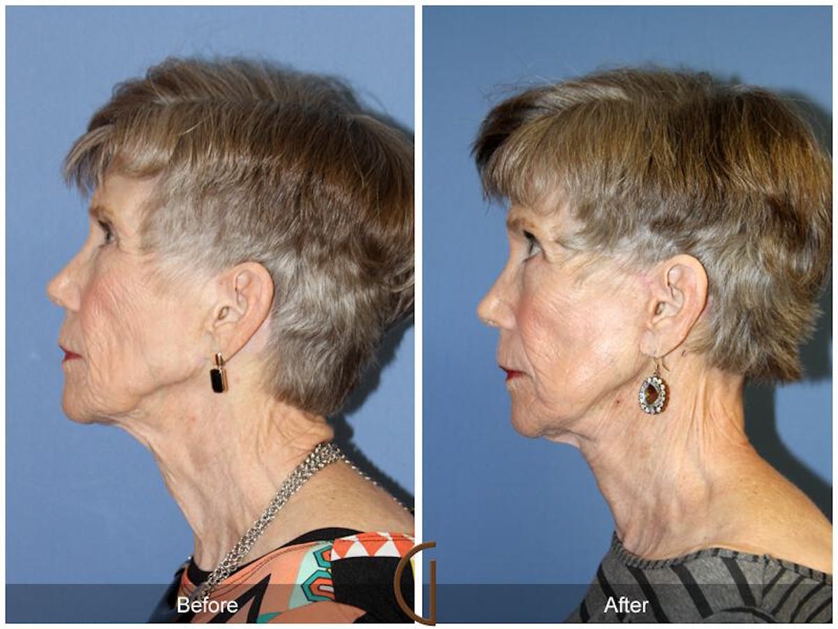 Facelift 70s Before & After Gallery - Patient 388116 - Image 1