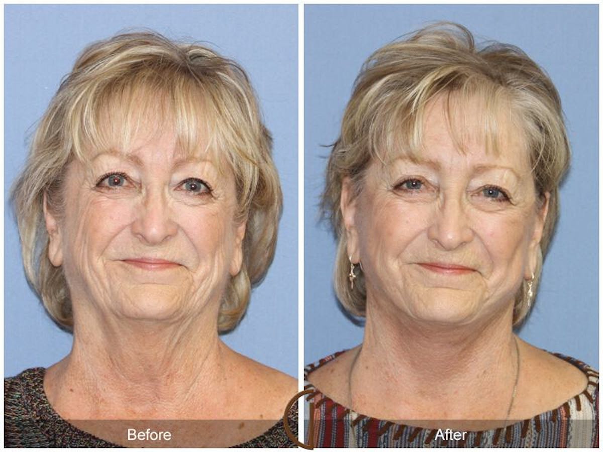 Facelift 70s Before & After Gallery - Patient 235710 - Image 2