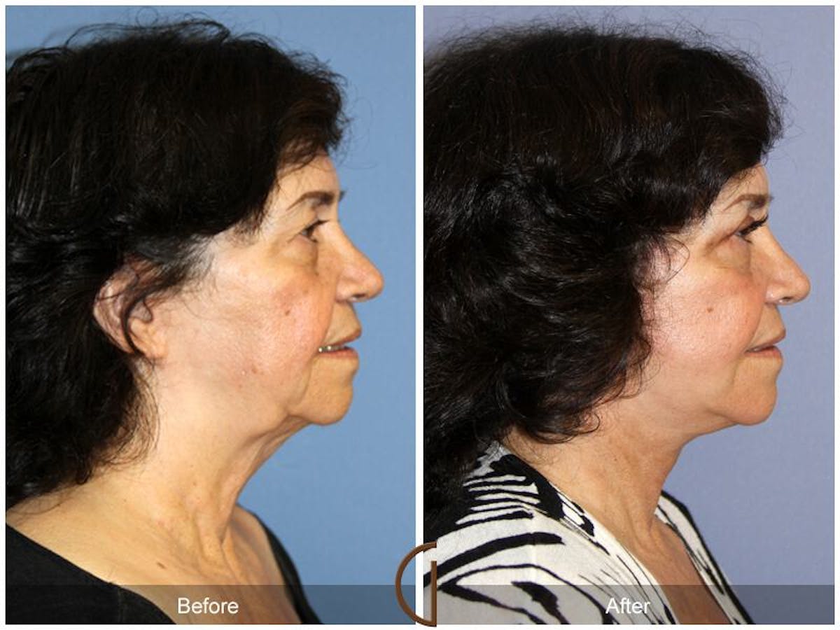 Facelift 70s Before & After Gallery - Patient 325388 - Image 3