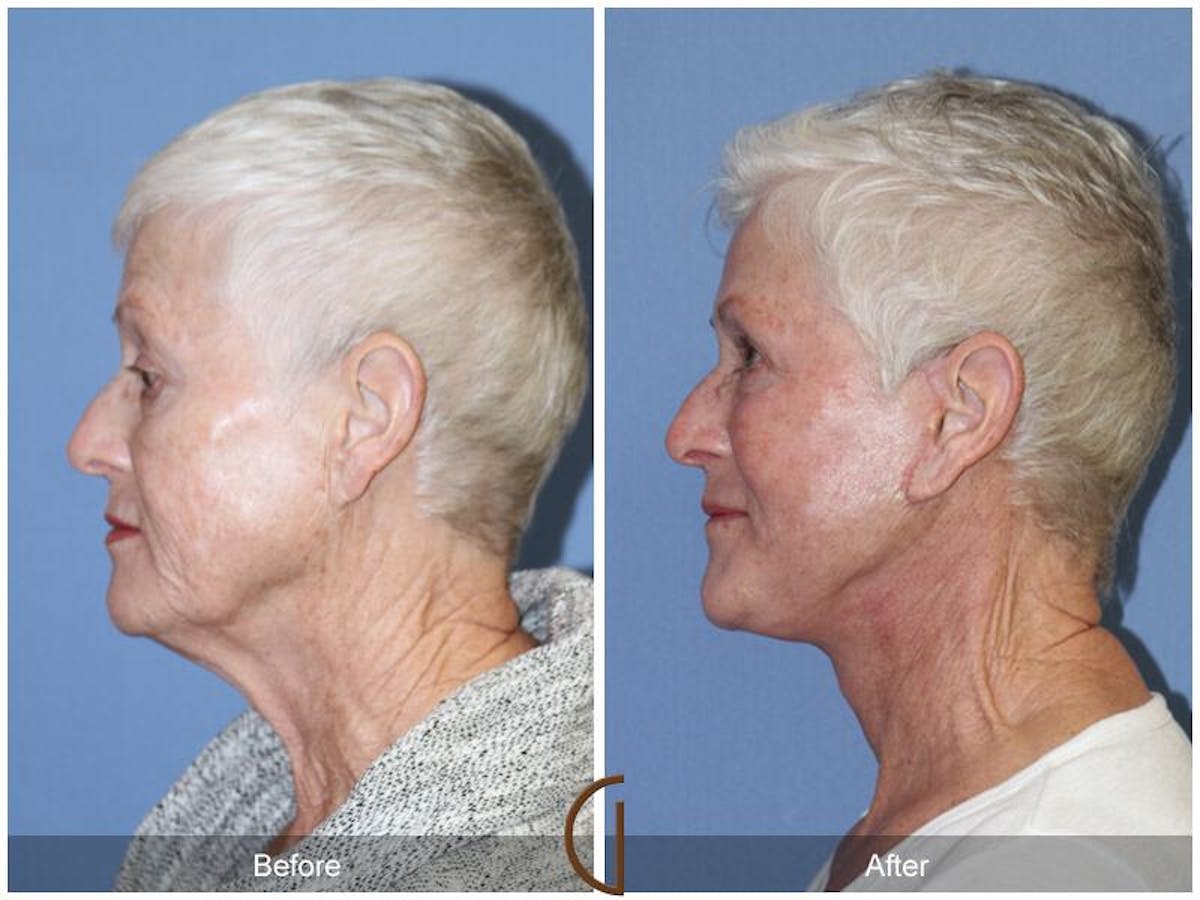 Facelift 70s Before & After Gallery - Patient 169569 - Image 1