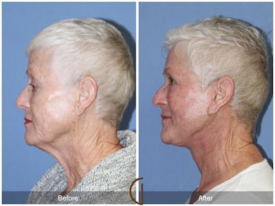 Facelift 70s Before & After Gallery - Patient 169569 - Image 1