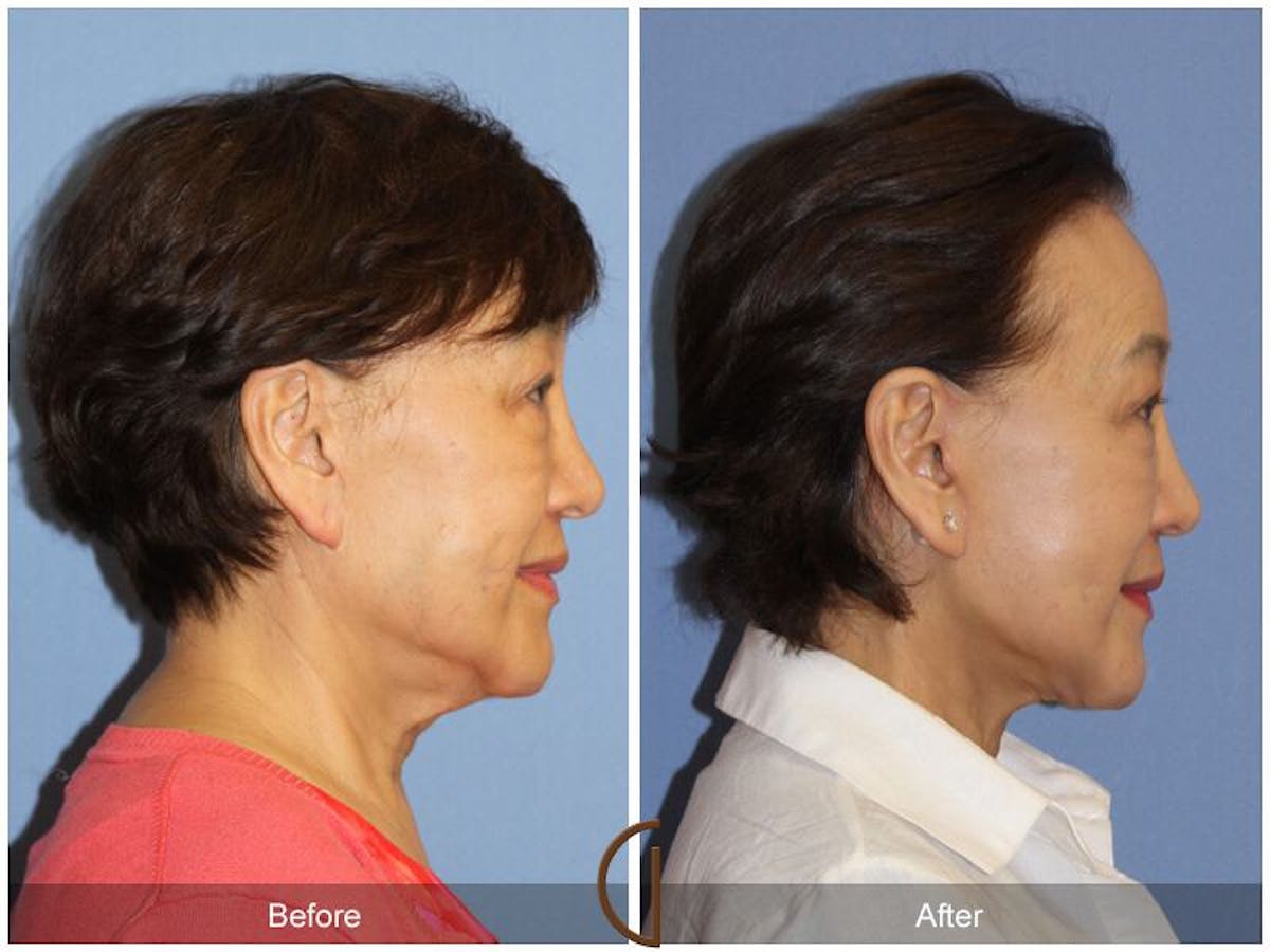 Facelift 70s Before & After Gallery - Patient 386180 - Image 3