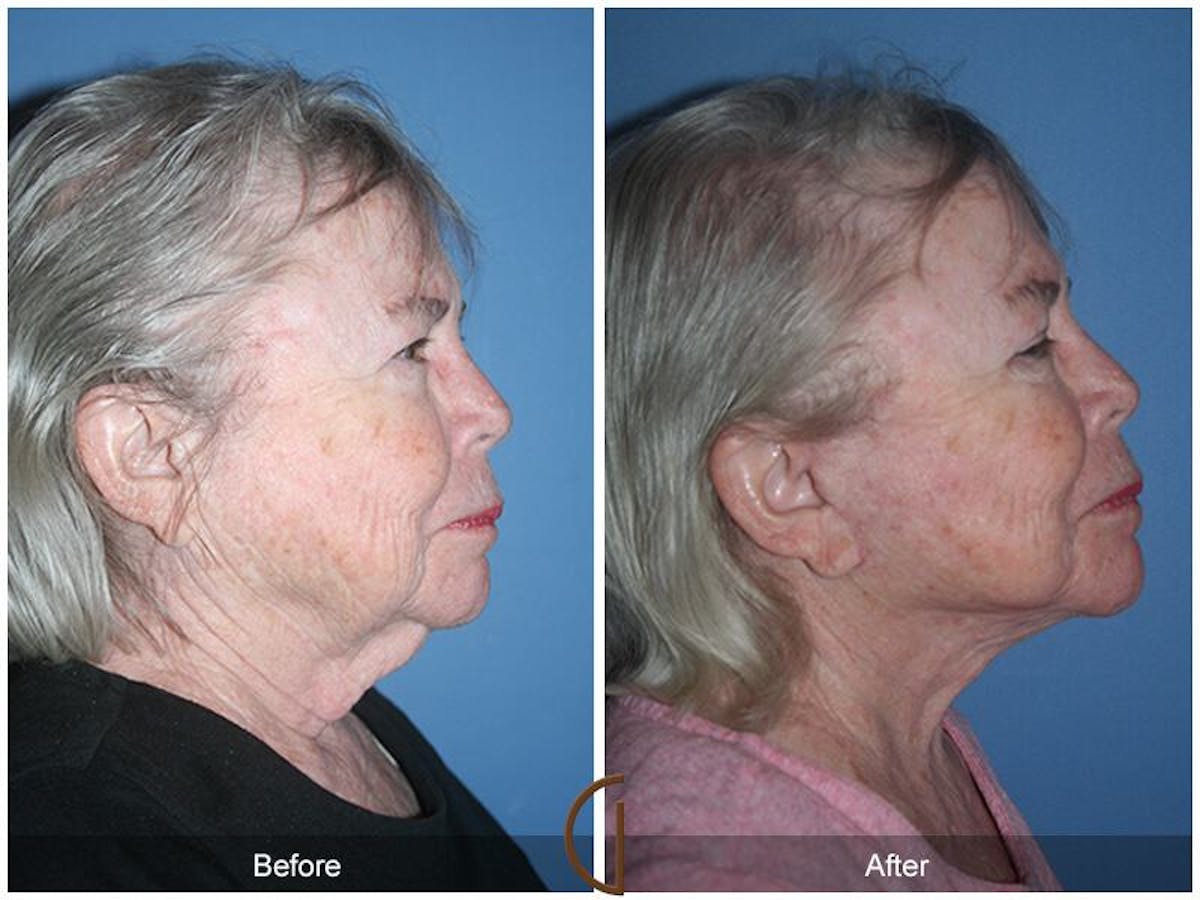 Facelift 70s Before & After Gallery - Patient 329939 - Image 3