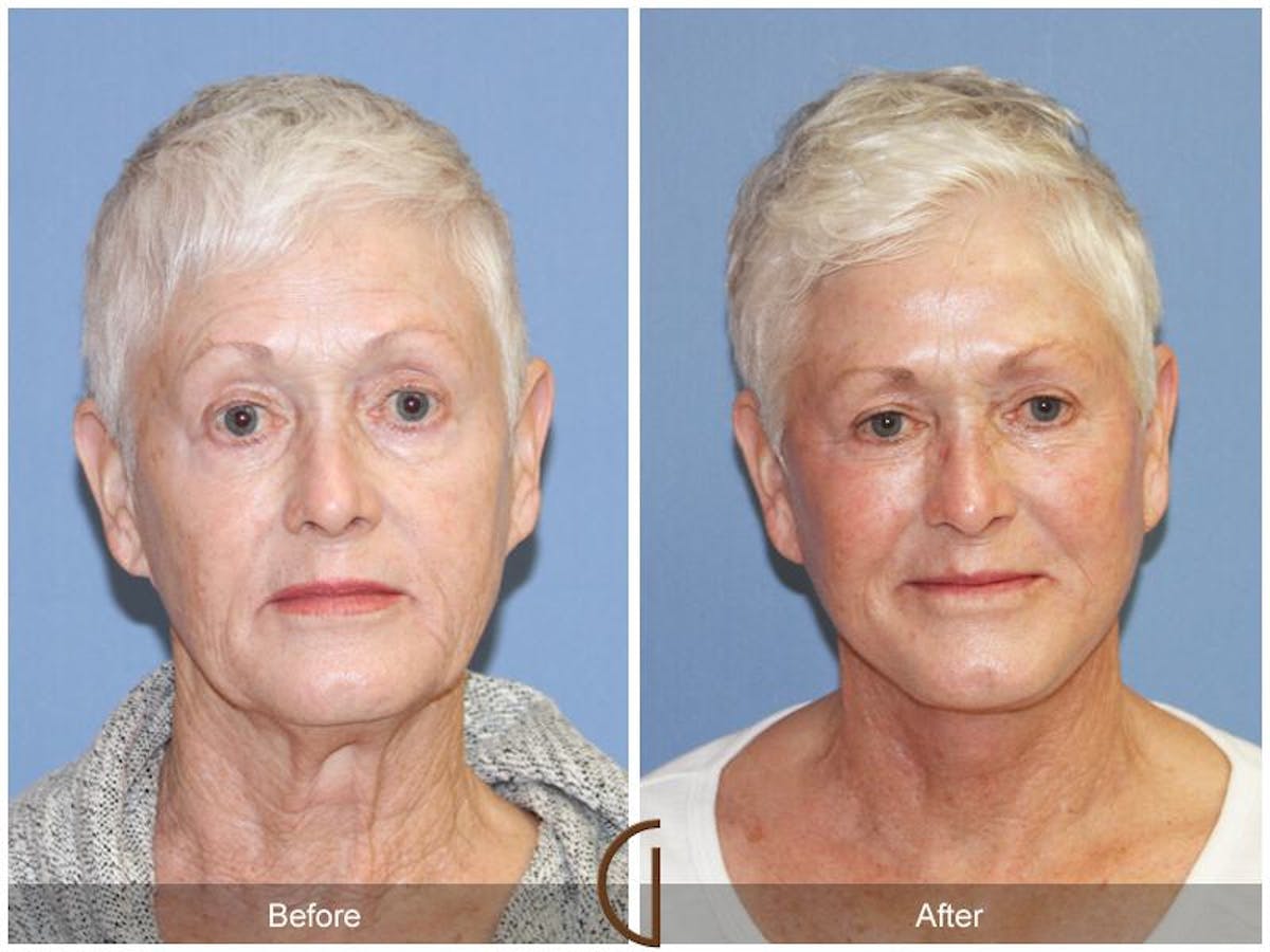 Facelift 70s Before & After Gallery - Patient 169569 - Image 2