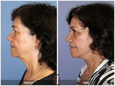 Facelift 70s Before & After Gallery - Patient 325388 - Image 1