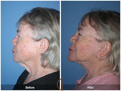Facelift 70s Before & After Gallery - Patient 329939 - Image 1