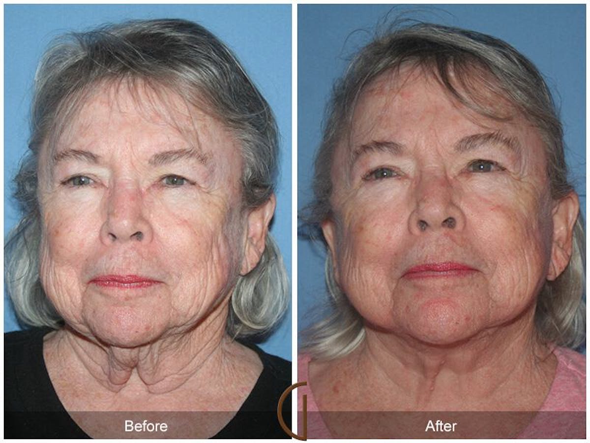 Facelift 70s Before & After Gallery - Patient 329939 - Image 2