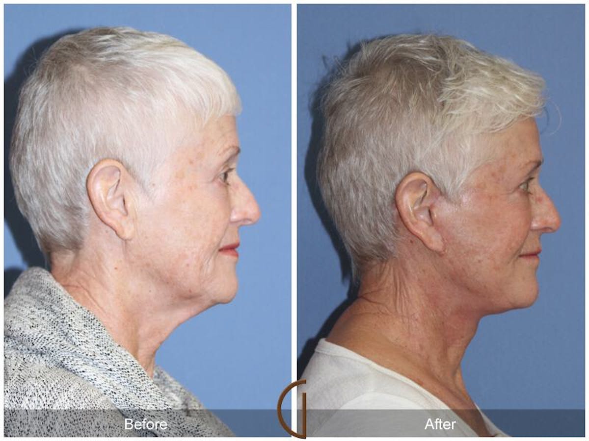 Facelift 70s Before & After Gallery - Patient 169569 - Image 3