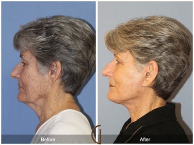 Facelift 70s Before & After Gallery - Patient 181977 - Image 1